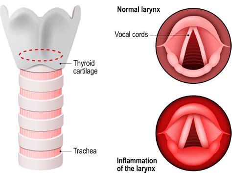 Understanding Laryngitis: Causes and Symptoms - Parkland Natural Health