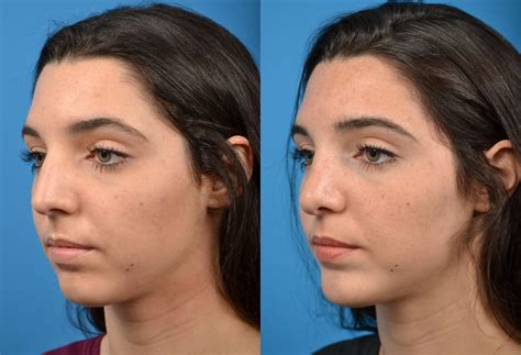 Rhinoplasty Photos | Melbourne, FL | Patient 16156