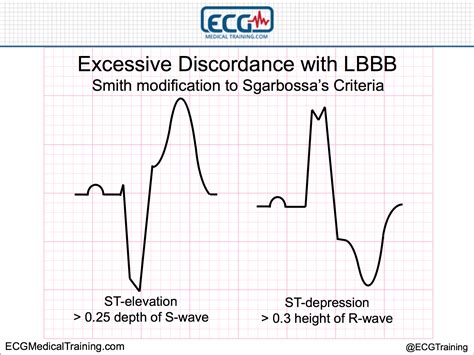 Making Sense of Sgarbossa’s Criteria – Chest Pain and Left Bundle Branch Block – Part 3 - ECG ...