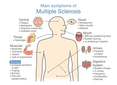 MS Explained: Physical Therapy Treatment for Multiple Sclerosis