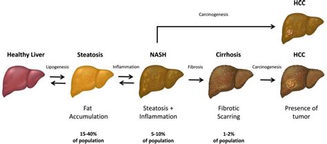 Importance of the liver extracellular matrix in the development of NASH ...