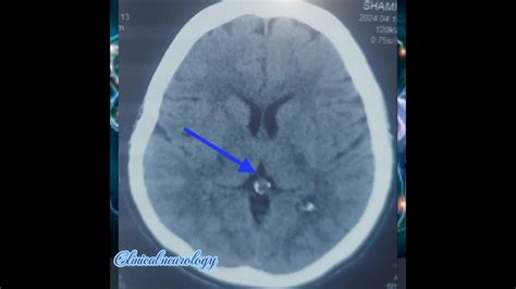 Pineal gland calcification on CT brain plain #pineal #glands #ct #brain ...