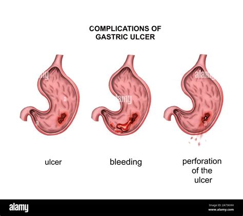 Complications of gastric ulcer. Bleeding and perforation Stock Photo ...