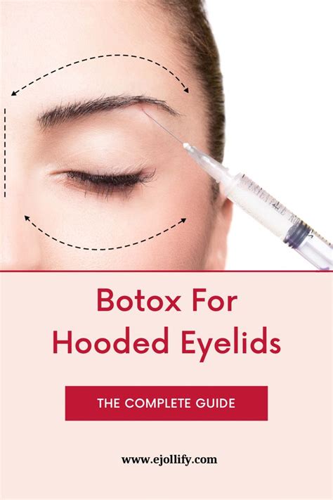 Hooded Eyelids Botox Before And After