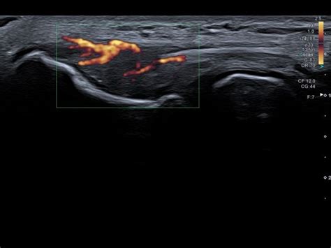 Partial tear common extensor tendon | Ultrasound Cases