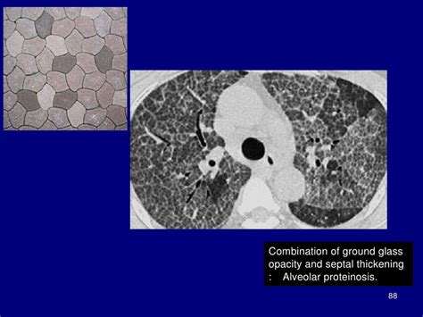 Technical aspect of hrct; normal lung anatomy & hrct findings of lung…