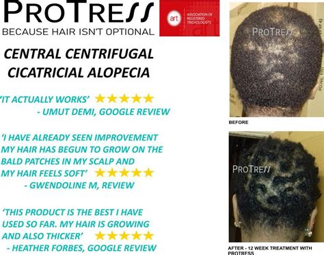 CENTRAL CENTRIFUGAL CICATRICIAL ALOPECIA