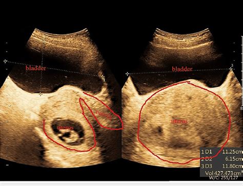 Abdominal ultrasound shows a retroverted uterus and a full bladder ...