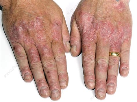 Psoriasis of the hands - Stock Image - C023/8947 - Science Photo Library