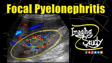 Pyelonephritis Ultrasound