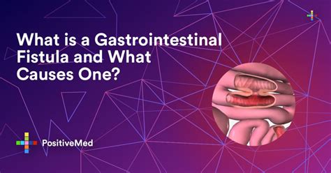 What is a Gastrointestinal Fistula and What Causes One? - PositiveMed