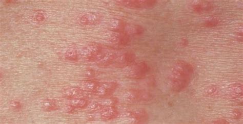 Rash on inner Thigh, Causes, Itchy, Male, Female, Treatment - Treat MD