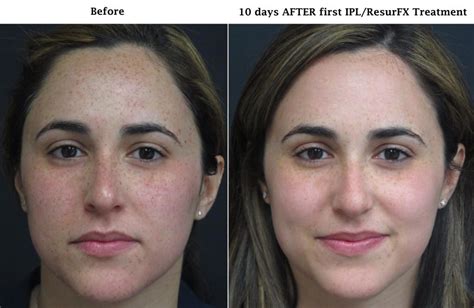 Treating Unwanted Brown Spots - Central Florida Dermatology Associates