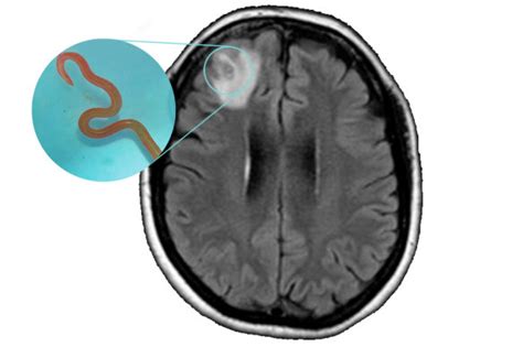 Worm in brain: Did warrigal greens cause a parasite in a human’s brain?