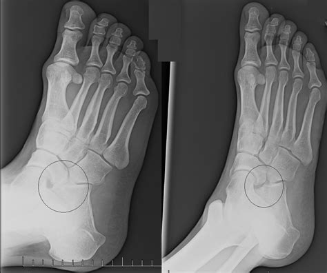 Tarsal Coalition: Tarsal Resection Before and After X rays