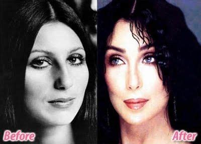 Celebrities Before and After Plastic Surgery | Cher plastic surgery, Celebrity plastic surgery ...