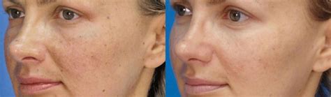 Micro Laser Peel Before and After Pictures Denver, Highlands Ranch, CO