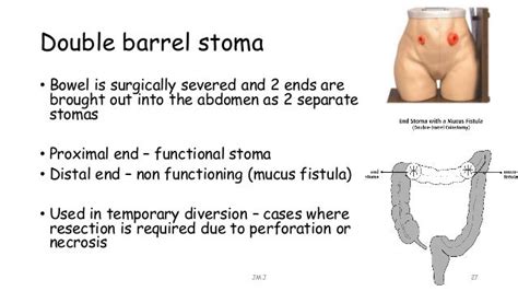 Stoma