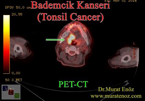 Tonsil Cancer - Causes, Symptoms, Diagnosis and Treatment