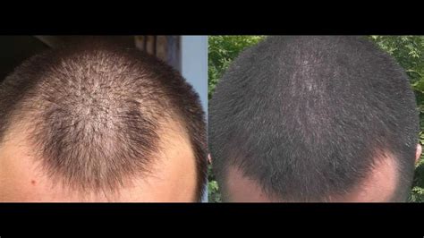 1 year minoxidil hair regrowth results, before and after. 2013! - YouTube