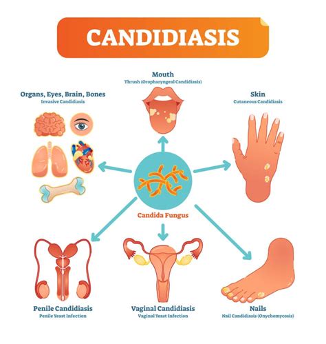 Why test Candida on a DAT? - Precision Point Diagnostics