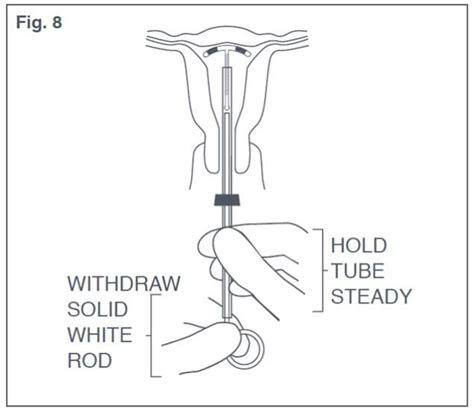 Copper Iud Insertion