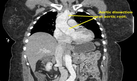 Cureus | Aortic Dissection Presenting as Leg Pain