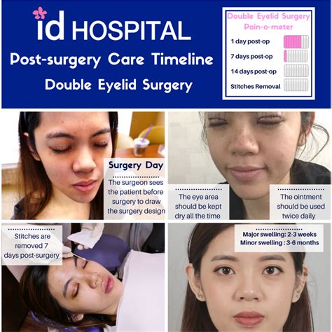 Eyelid surgery recovery process, tips & photos - IDHOSPITAL