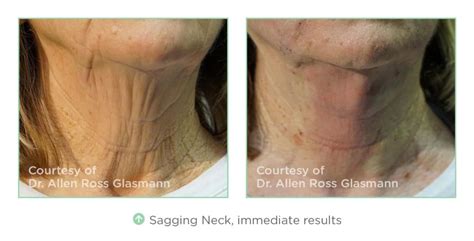 nt-before-after-sagging-neck | #① NYC Botox, Juvederm, Dysport ...