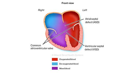 Atrioventricular Canal Defect Diagnosis Treatments Mount Sinai | My XXX Hot Girl