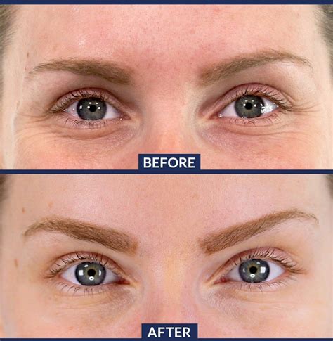 Eyebrow lift! See natural, long lasting results by Dr. Marina Shlifer # ...