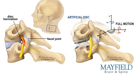 Cervical Disc Replacement Procedure