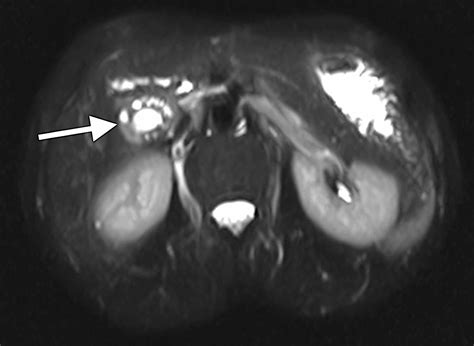 Cureus | Gallbladder Adenomyomatosis Presenting With Abdominal Pain