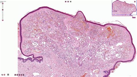 Hemangioma Histology