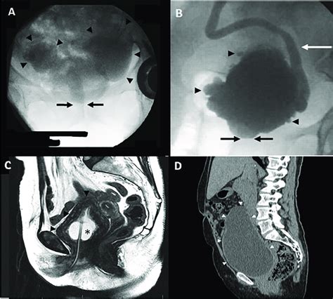 Baseline imaging studies illustrating bladder damage secondary to PBNO ...