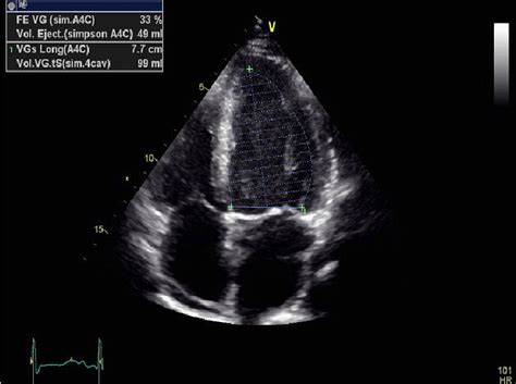 Transthoracic echocardiography revealing left ventricular dysfunction ...