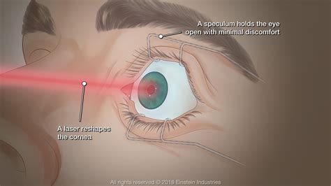 PRK Eye Surgery