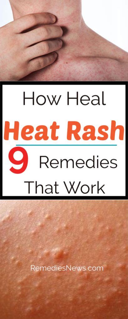 How to Get Rid of Heat Rash Quickly – 9 Remedies That Work