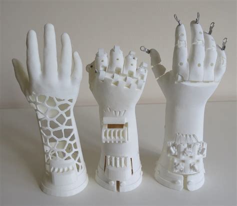 SLS Nylon 3D Printed Prosthetic Hand Seeks Funding on GoFundMe ...