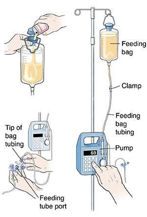 Continuous Tube Feeding | Saint Luke's Health System