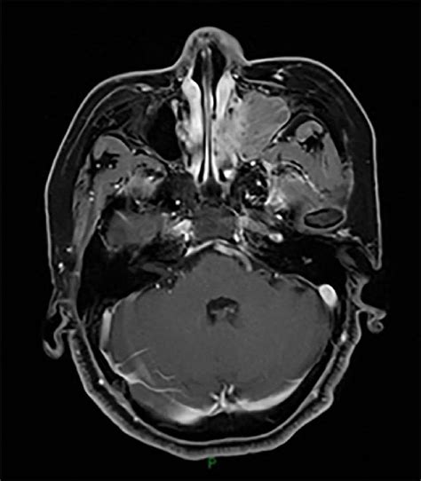 MRI image taken before the first sinus tumor resection. | Download Scientific Diagram