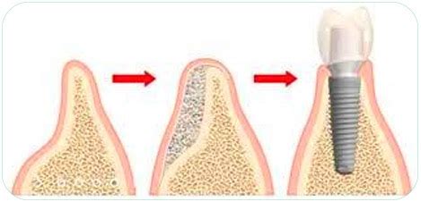 Implant dentaire Tunisie : Prix pas cher