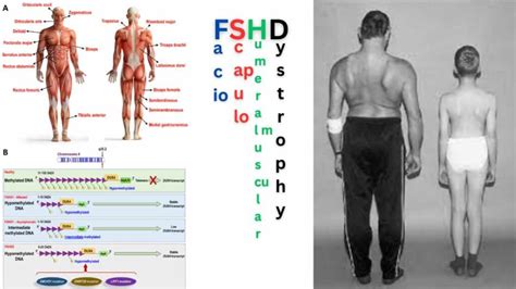 Facioscapulohumeral Muscular Dystrophy (FSHD): Unraveling The Rare ...