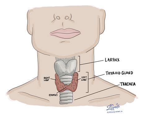 Carcinoma folicular de tiroides angioinvasivo encapsulado - MyPathologyReport.ca (2023)