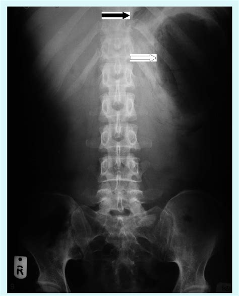 Abdominal X-Ray, showing the displaced stomach bubble (black arrow).... | Download Scientific ...