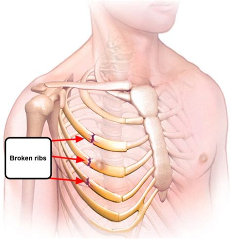 Broken Rib - Causes, Signs, Symptoms, Recovery Time & Treatment