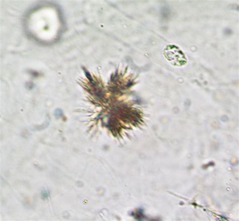 Urine Sediment of the Month: Pathologic Crystals in the Urine - Renal ...