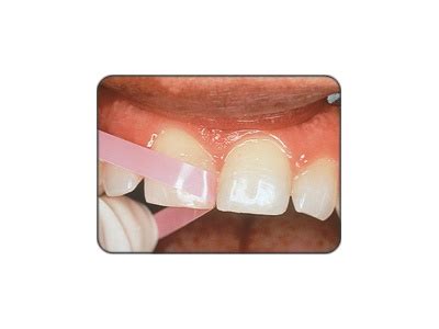 Dental Finishing Strips | Dentalcompare.com