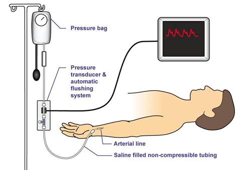 arterial line | PT :) | Pinterest | Nurse stuff and Nursing students