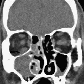 Pretreatment coronal CT: right maxillary sinus opacification with ...